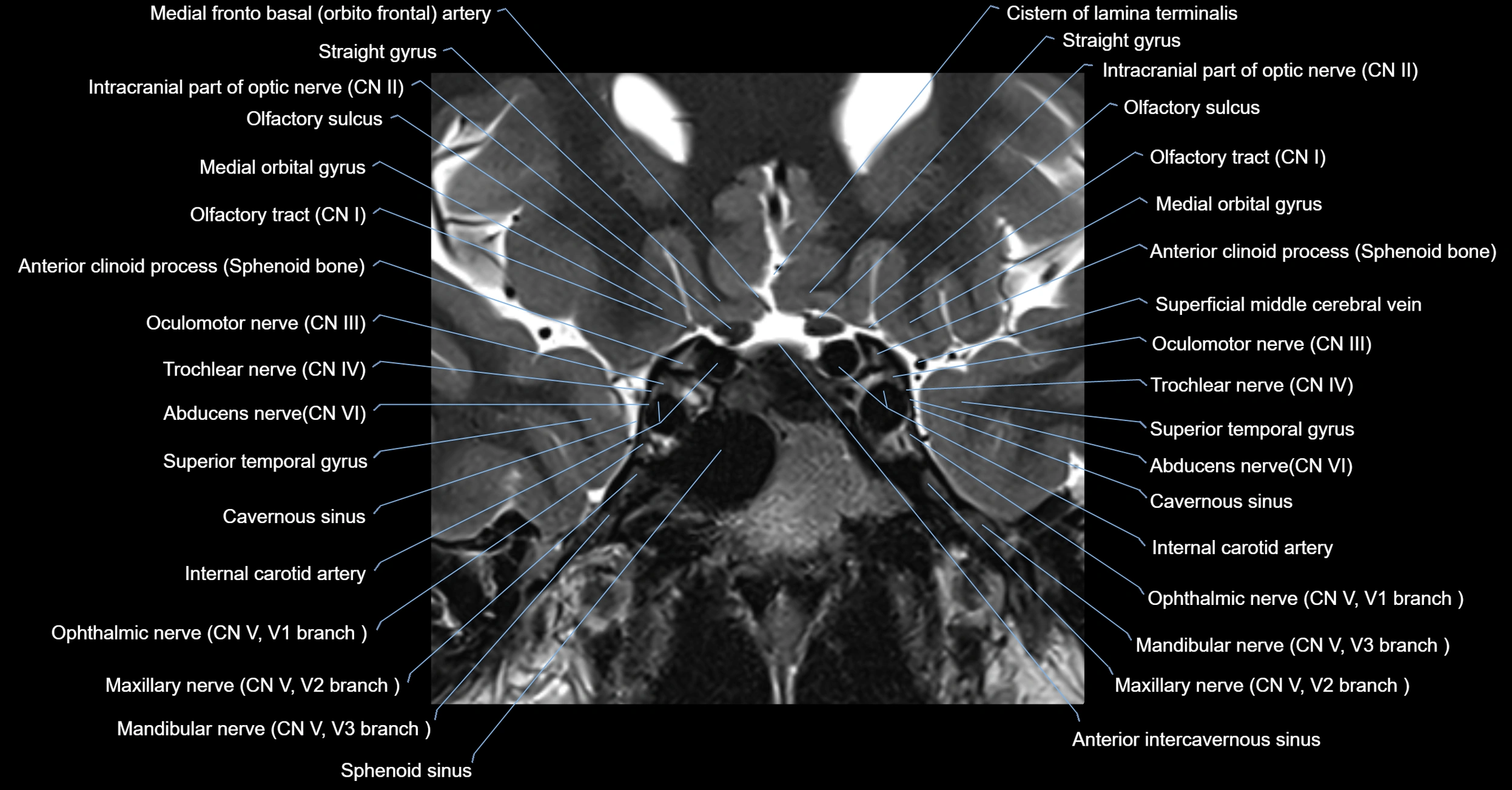 MRI cavernous sinus coronal cross sectional 3T anatomy image-img-00001-00008.webp